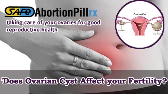 Ovarian-Cyst